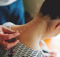 Scott Martin Acupuncture - Renee