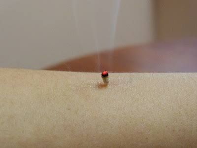 Acupuncture @ Beerwah - Renee 1