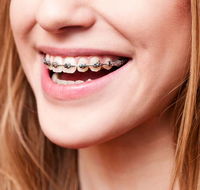 Cairns Specialist Orthodontists - Renee