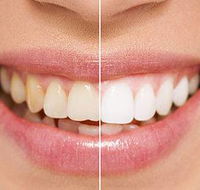 Newcastle Dental Care - Renee