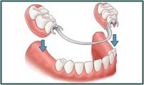 Denture Success - Renee 0