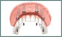 Denture Success - Renee 2