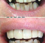 Your Dentist Gunnedah - Renee