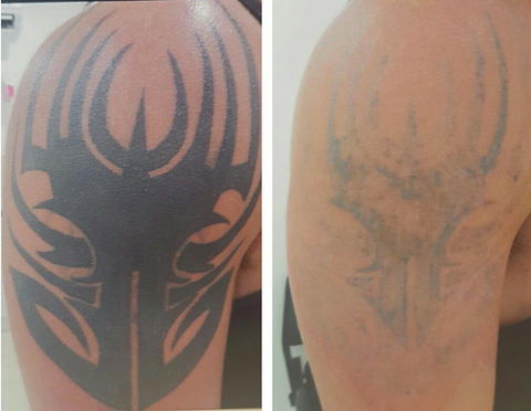 Laserpro Tattoo Removal - Petrol Stations 1