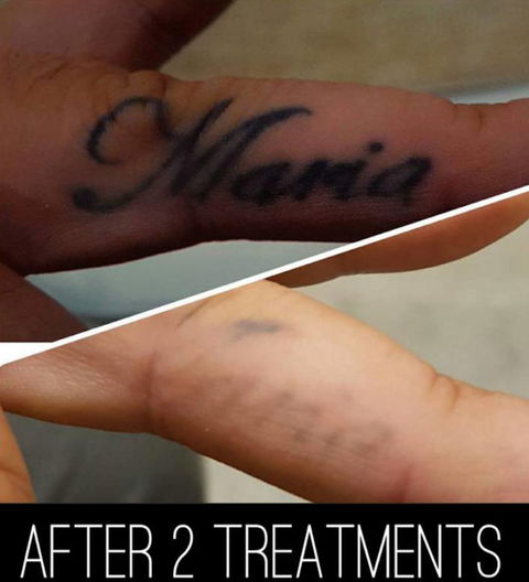 Laserpro Tattoo Removal - Petrol Stations 2