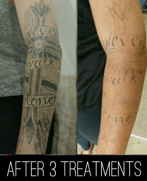 Laserpro Tattoo Removal - Petrol Stations 3