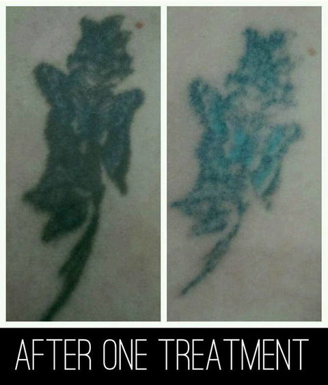 Laserpro Tattoo Removal - Petrol Stations 4