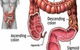 Colonics–Colon Hydrotherapy - thumb 1